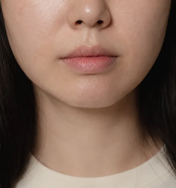 써마지